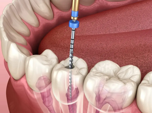 Root Canal Treatment