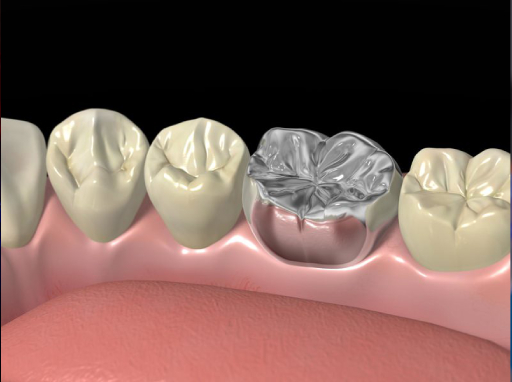 Dental Crowns