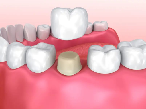 Dental Crowns